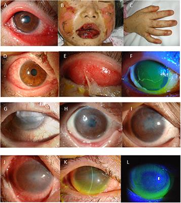 Japan: Diagnosis and Management of Stevens-Johnson Syndrome/Toxic Epidermal Necrolysis With Severe Ocular Complications